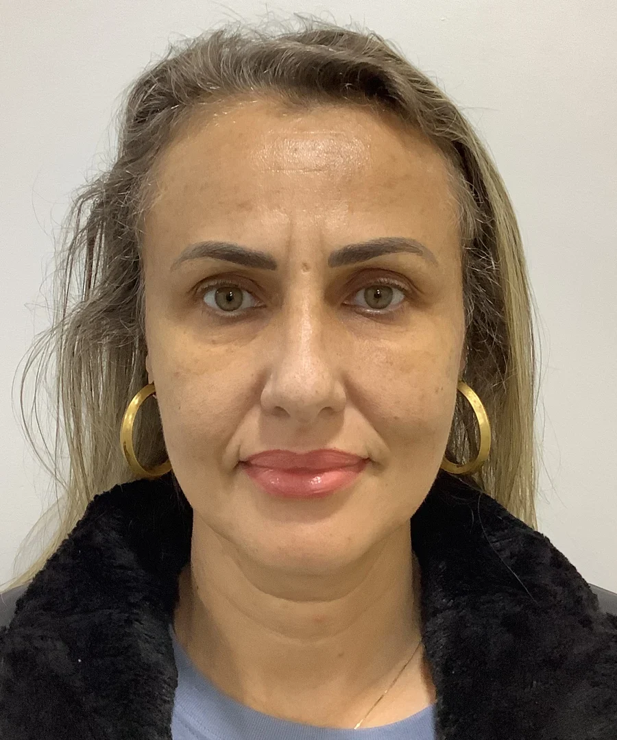 Fotona melasma treatment after, Advanced Aesthetics, Medford and Braintree MA