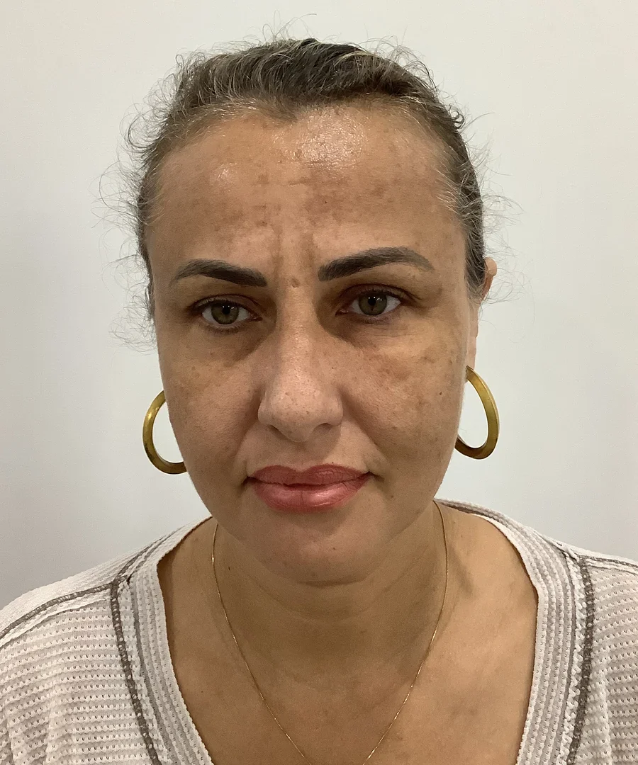 Fotona melasma treatment before, Advanced Aesthetics, Medford and Braintree MA