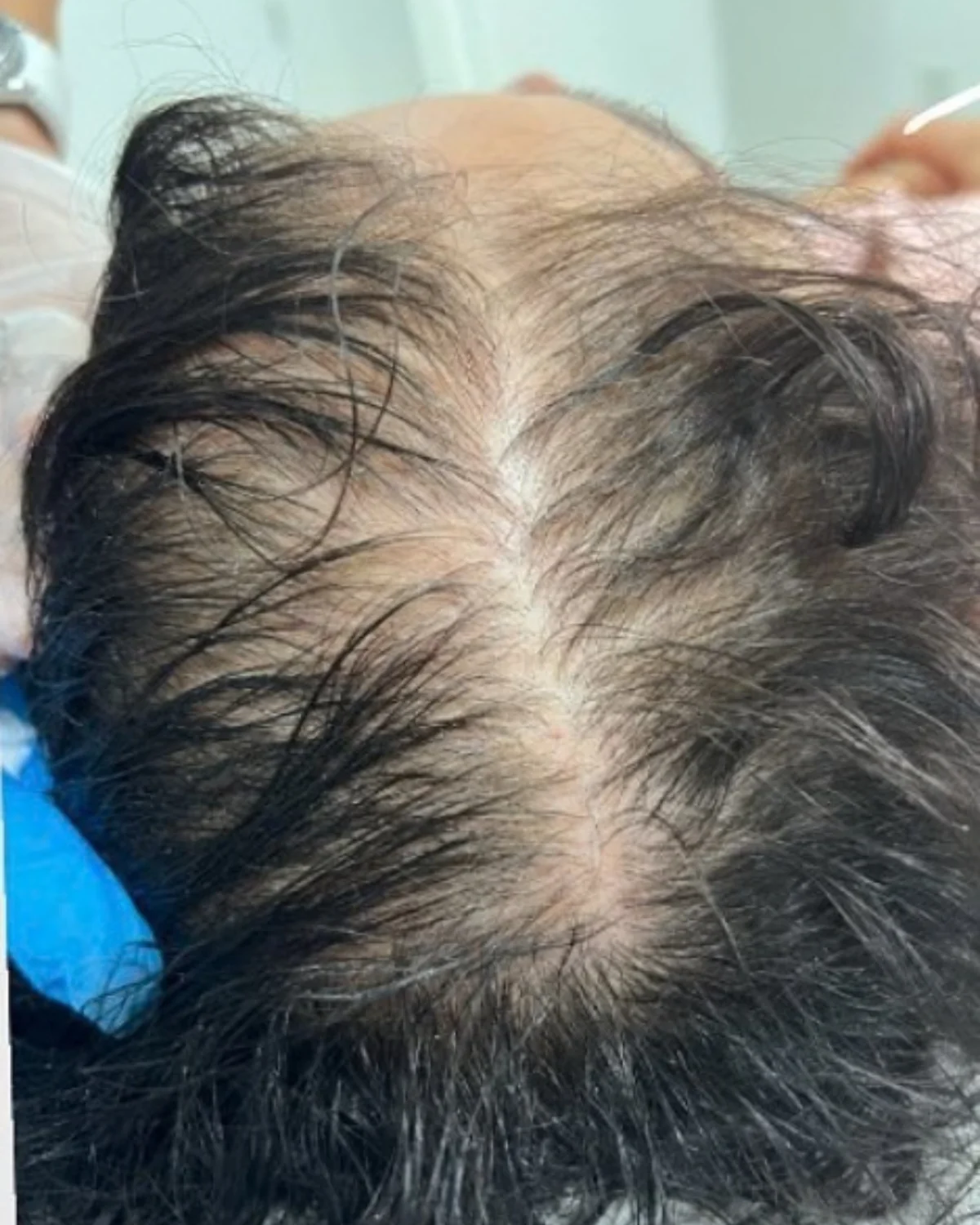 PRFM Hair Restoration before treatment at Advanced Aesthetics, Medford and Braintree MA
