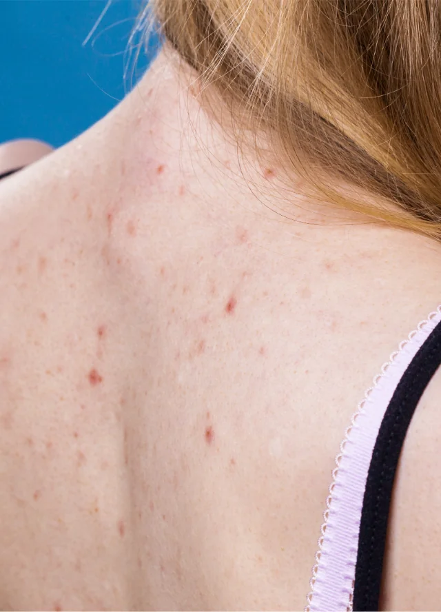 Close view of breakouts on a woman's back
