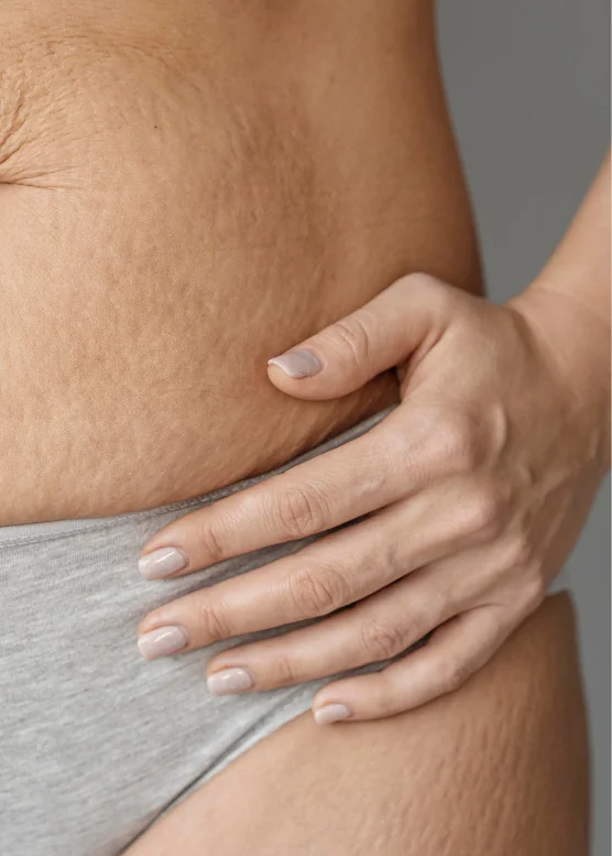 Close view of stretch marks on a woman's abdomen