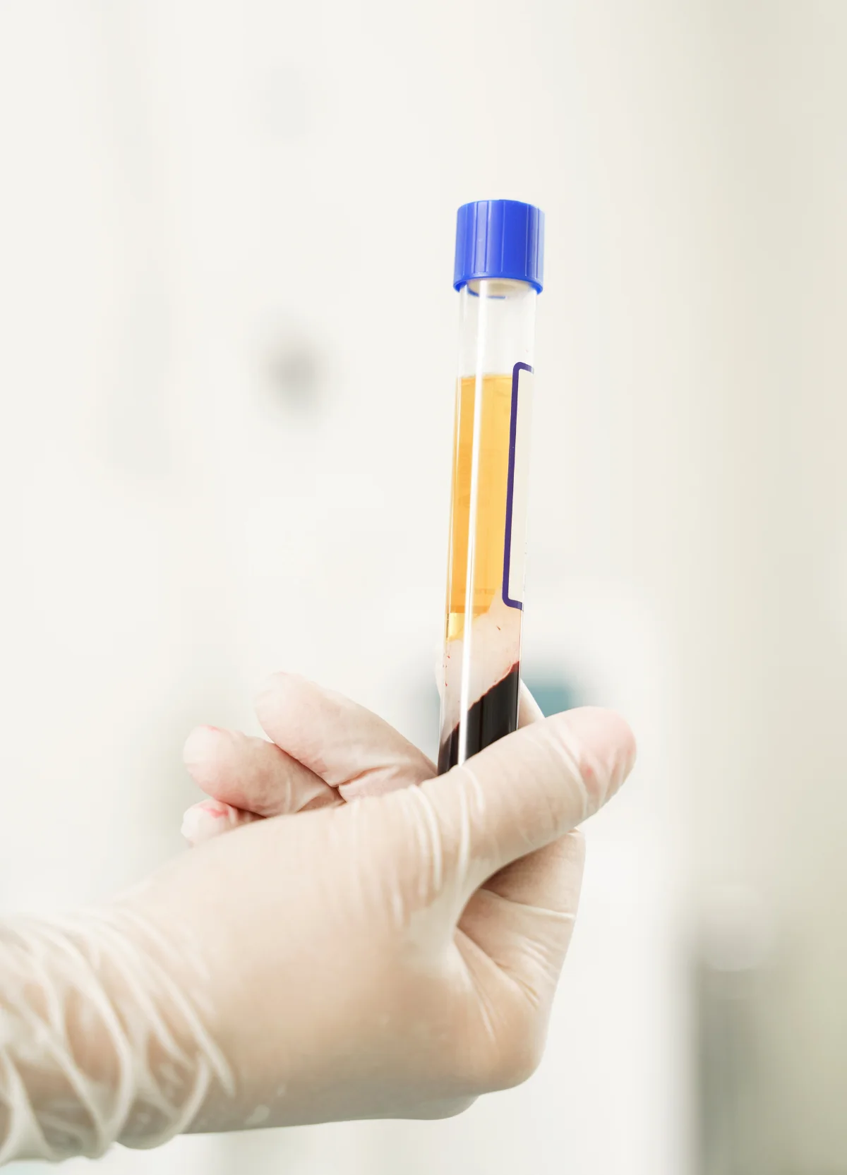 Gloved hand holding a platelet-rich plasma tube
