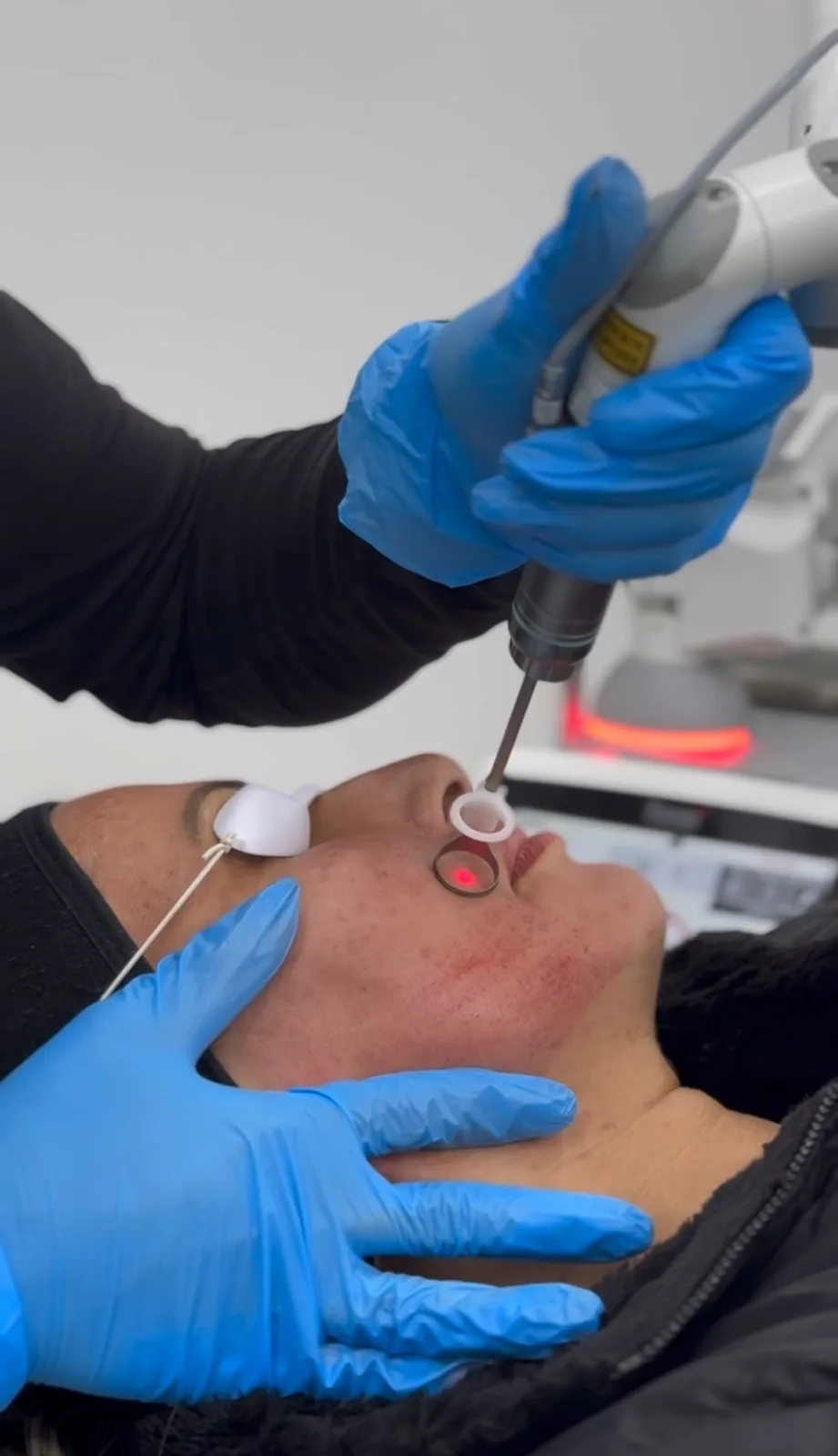 Fotona Pigment Eraser laser treatment for melasma at Advanced Aesthetics