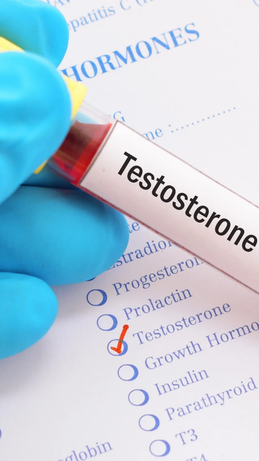Testosterone blood sample with a hormone testing checklist