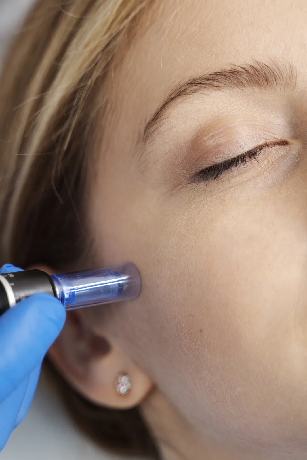 Microneedling device along the temple during a collagen induction treatment