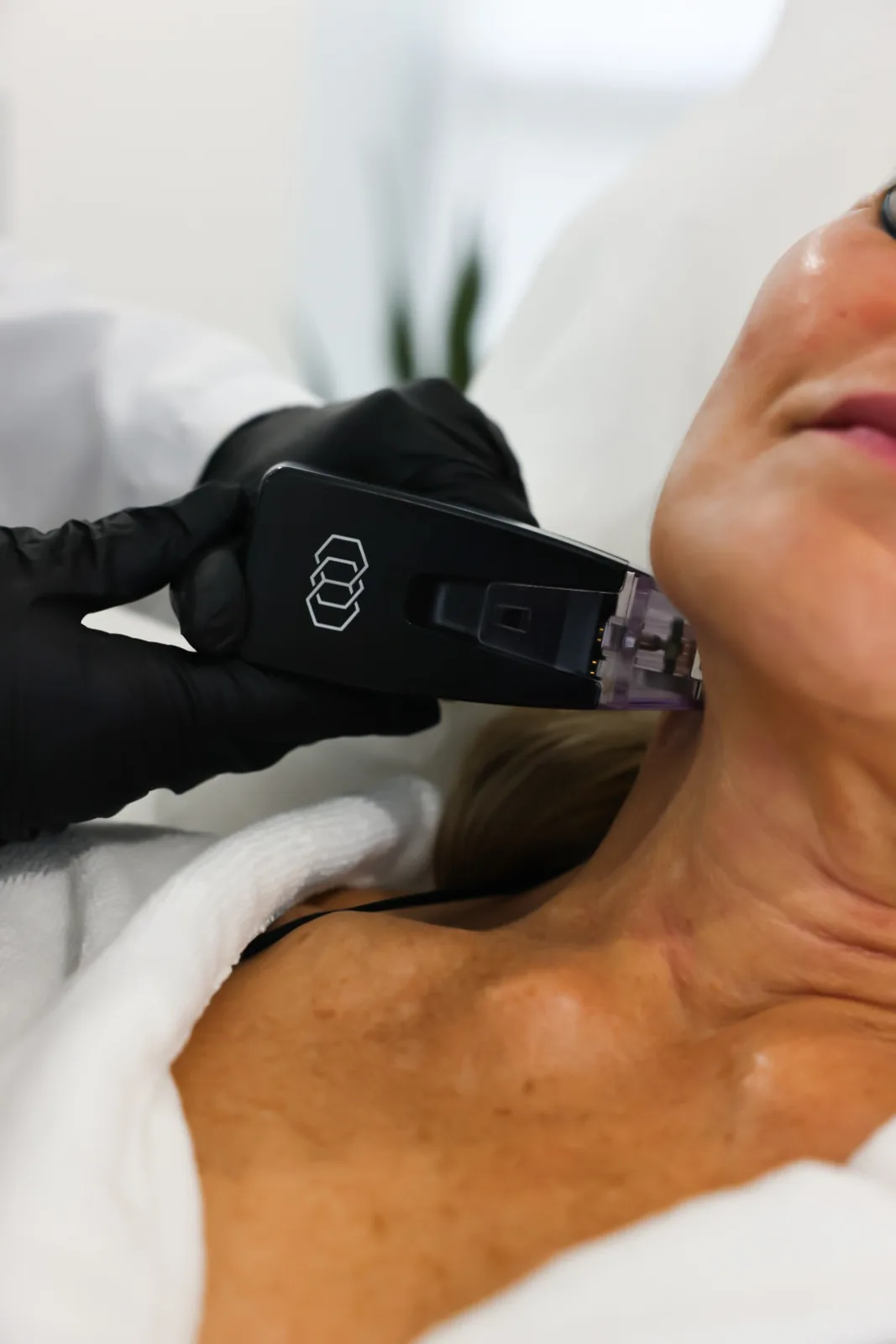 Morpheus8 RF microneedling on the neck at Advanced Aesthetics