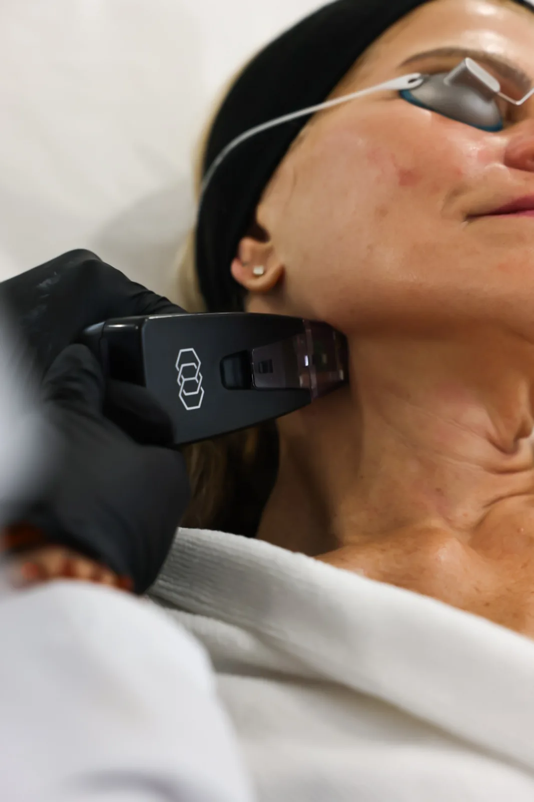 Morpheus8 handpiece along the jawline at Advanced Aesthetics
