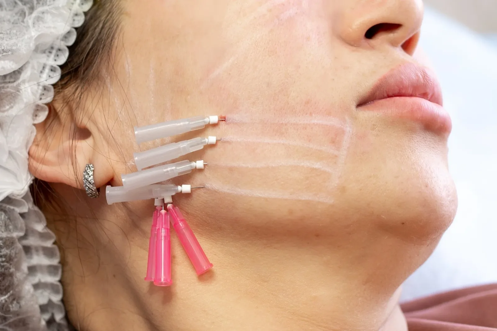 PDO threads placed along the jawline for a non-surgical lift, Advanced Aesthetics Medford and Braintree MA