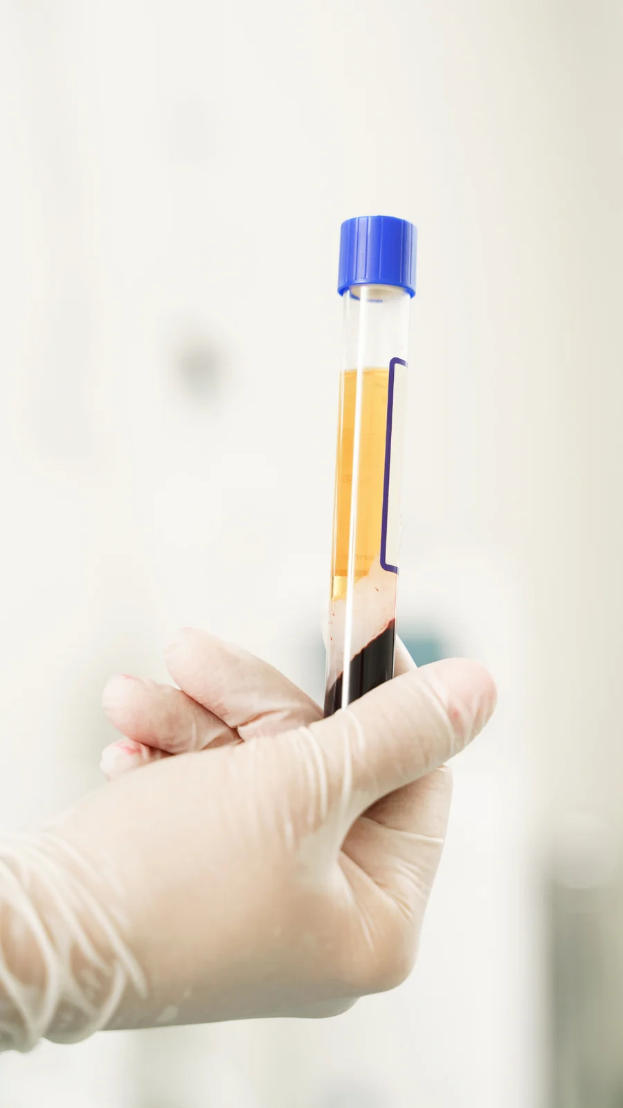 Gloved hand holding a platelet-rich plasma preparation tube
