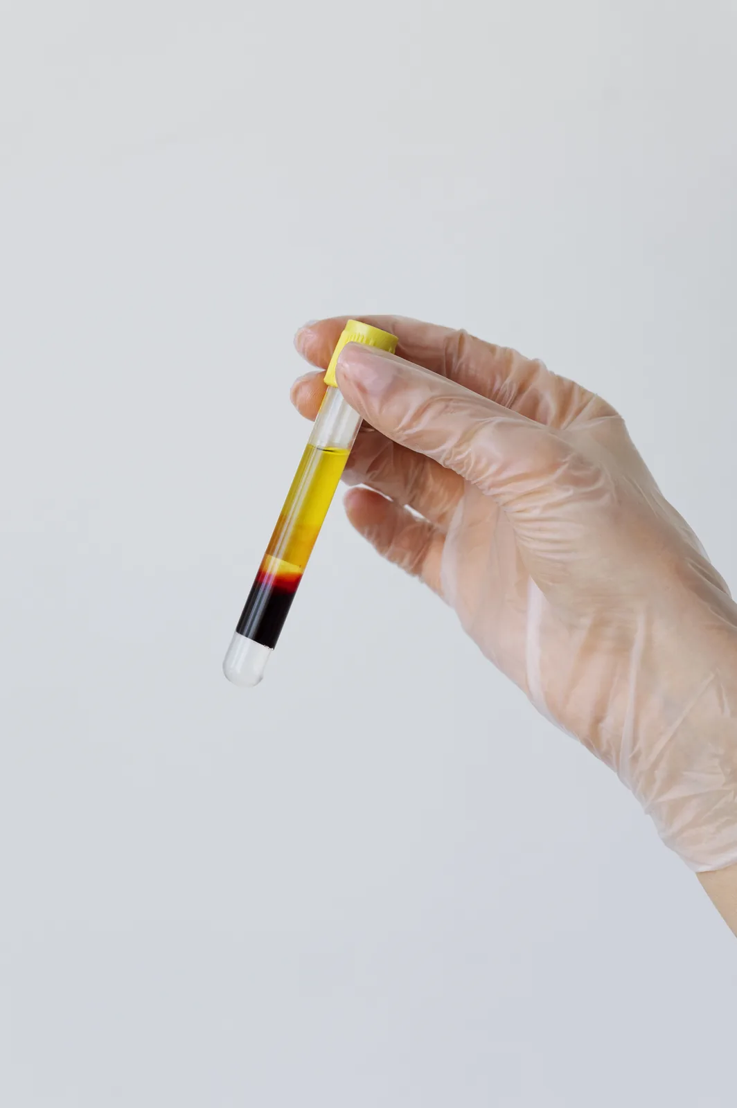 Gloved hand holding a platelet-rich plasma tube