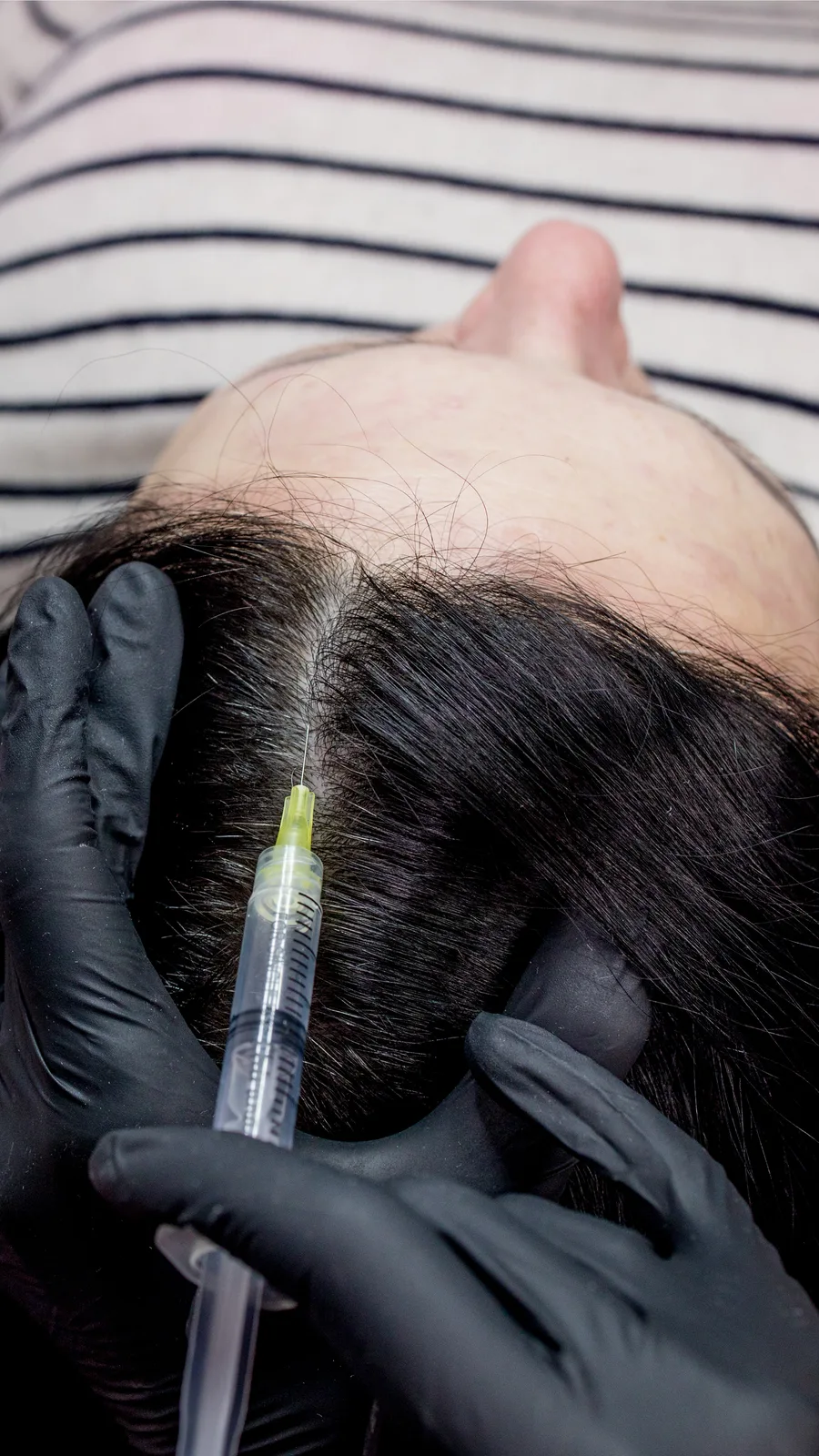 Scalp injection along the part line for hair restoration at Advanced Aesthetics