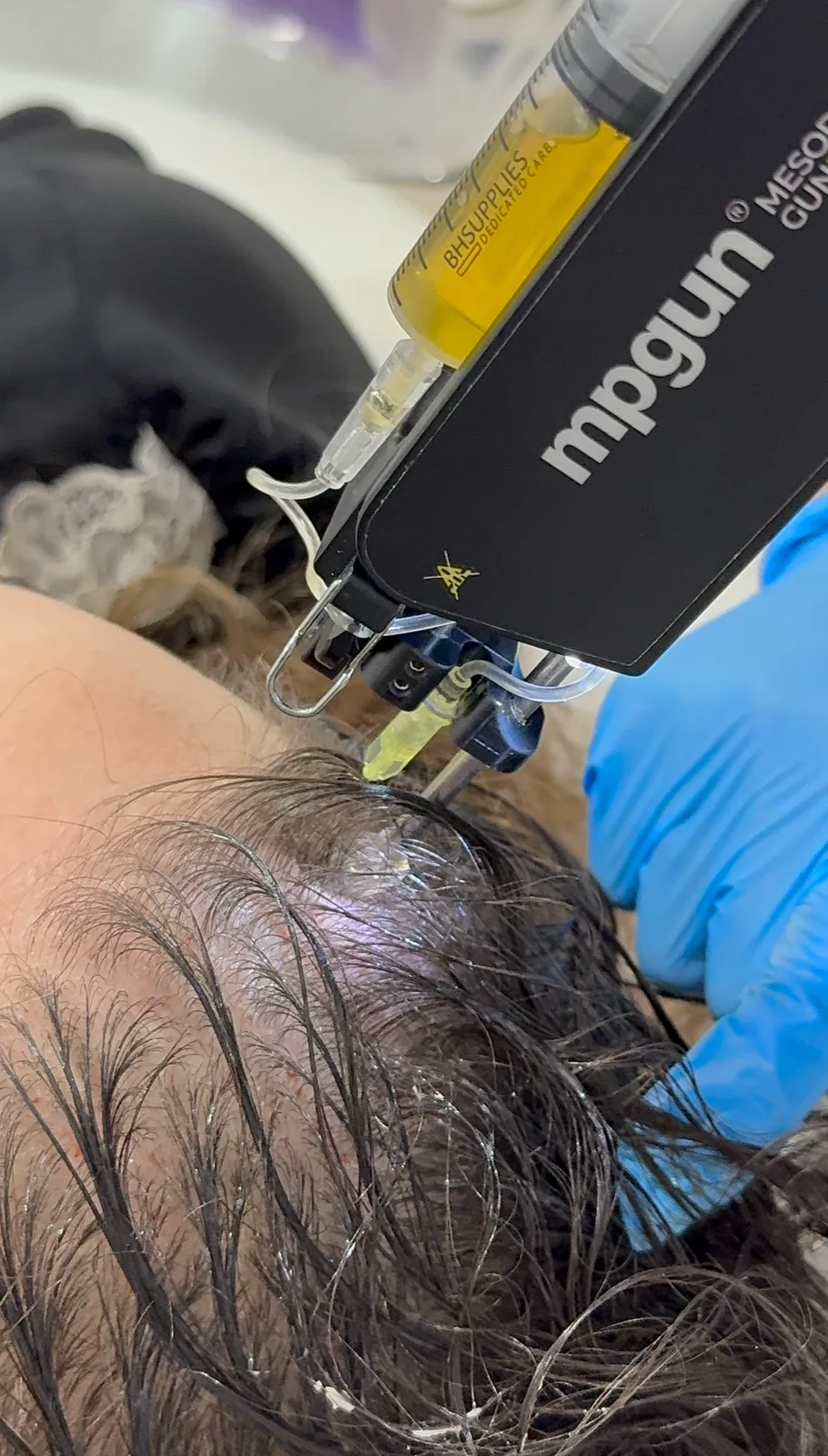PRP being injected into the scalp for hair restoration at Advanced Aesthetics